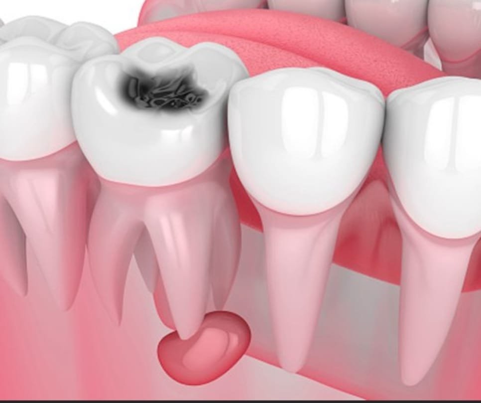 Oral-cyst-tumor-surgery Oral Cyst Tumor Surgery