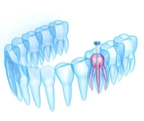 Post-and-core-therapy Post And Core Therapy