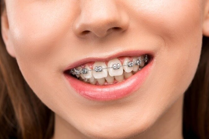 orthodontic orthodontic